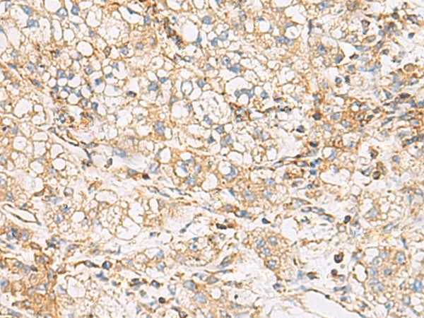 Immunohistochemistry of paraffin-embedded Human liver cancer tissue  using FYCO1 Polyclonal Antibody at dilution of 1:60(?200)