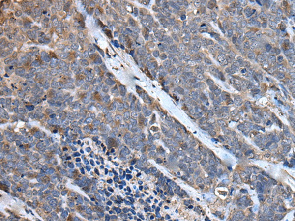 Immunohistochemistry of paraffin-embedded Human thyroid cancer tissue  using MCM10 Polyclonal Antibody at dilution of 1:50(?200)