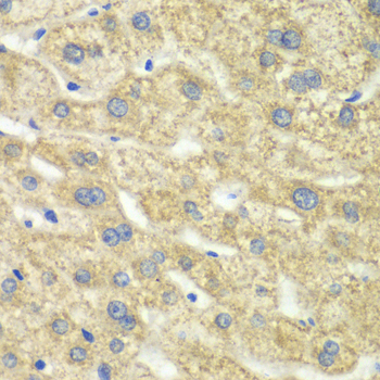 Immunohistochemistry of paraffin-embedded Human liver damage using DLD Polyclonal Antibody at dilution of 1:100 (40x lens).