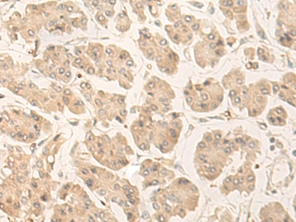 Immunohistochemistry of paraffin-embedded Human gastric cancer tissue  using FABP4 Polyclonal Antibody at dilution of 1:60(?200)