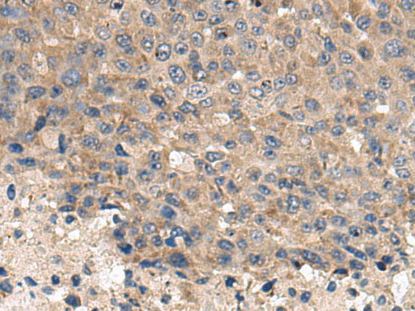 Immunohistochemistry of paraffin-embedded Human liver cancer tissue  using CD59 Polyclonal Antibody at dilution of 1:120(?200)