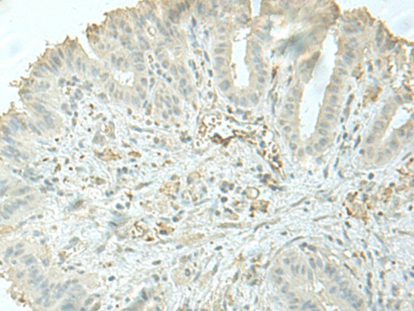 Immunohistochemistry of paraffin-embedded Human thyroid cancer tissue  using C8orf4 Polyclonal Antibody at dilution of 1:55(?200)