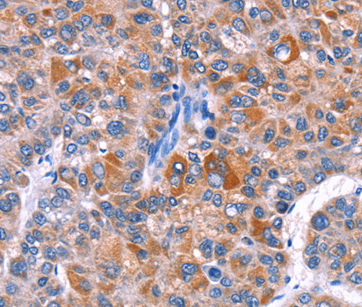 Immunohistochemistry of paraffin-embedded Human liver cancer tissue using ELP2 Polyclonal Antibody at dilution 1:40