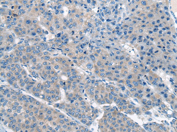 Immunohistochemistry of paraffin-embedded Human liver cancer tissue  using CITED4 Polyclonal Antibody at dilution of 1:65(?200)