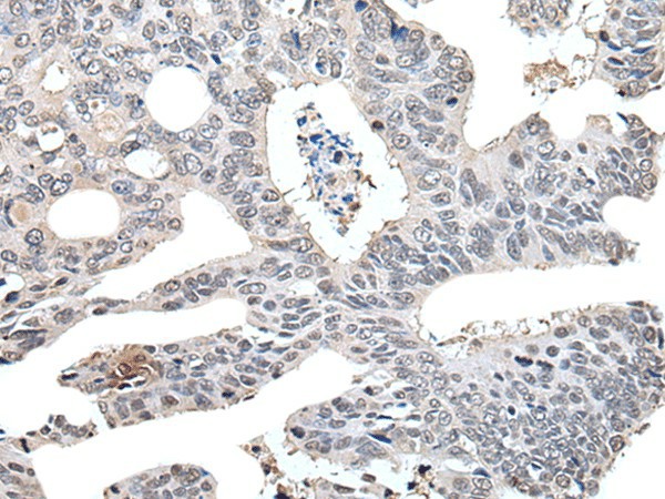 Immunohistochemistry of paraffin-embedded Human colorectal cancer tissue  using TCEB2 Polyclonal Antibody at dilution of 1:40(?200)