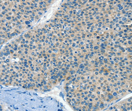 Immunohistochemistry of paraffin-embedded Human liver cancer tissue using HID1 Polyclonal Antibody at dilution 1:50