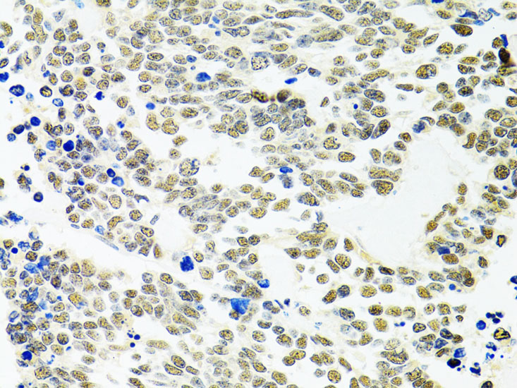 Immunohistochemistry of paraffin-embedded human lung cancer using PPP4C Polyclonal antibody at dilution of 1:100 (40x lens).Perform microwave antigen retrieval with 10 mM PBS buffer pH 7.2 before commencing with IHC staining protocol.