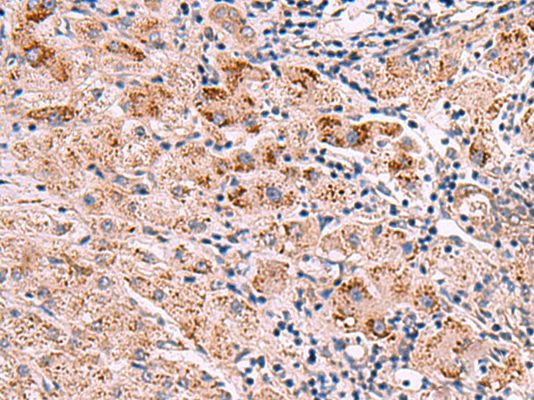 Immunohistochemistry of paraffin-embedded Human liver cancer tissue  using INPP5B Polyclonal Antibody at dilution of 1:40(?200)