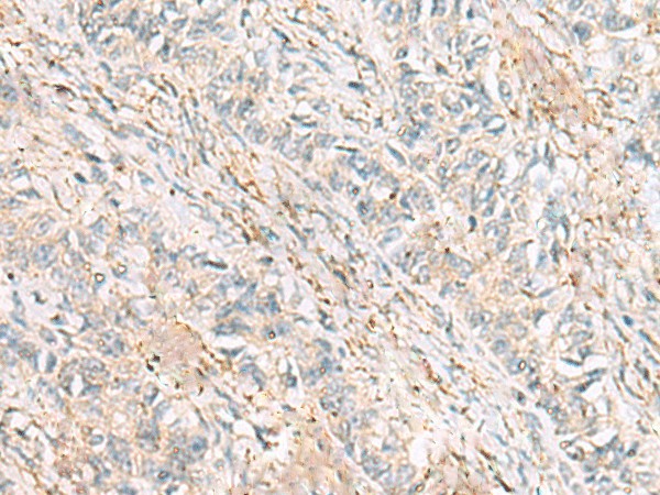 Immunohistochemistry of paraffin-embedded Human ovarian cancer tissue  using HBZ Polyclonal Antibody at dilution of 1:120(?200)