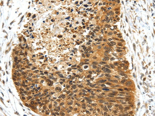 Immunohistochemistry of paraffin-embedded Human esophagus cancer using NR2F2 Polyclonal Antibody at dilution of  1/25