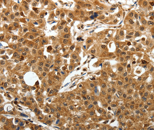 Immunohistochemistry of paraffin-embedded Human lung cancer using SOX-13 Polyclonal Antibody at dilution of 1:50