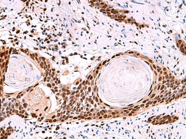 Immunohistochemistry of paraffin-embedded Human esophagus cancer tissue  using SF3B3 Polyclonal Antibody at dilution of 1:50(?200)