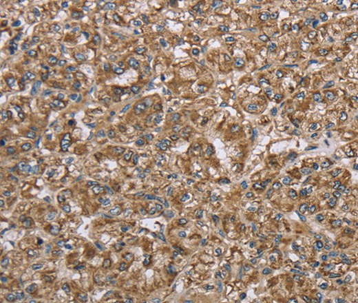 Immunohistochemistry of paraffin-embedded Human prostate cancer using CERS4 Polyclonal Antibody at dilution of 1:35