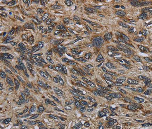 Immunohistochemistry of paraffin-embedded Human esophagus cancer tissue using CD236 Polyclonal Antibody at dilution 1:60