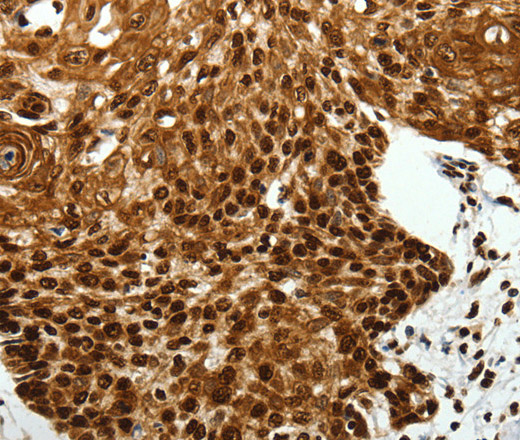 Immunohistochemistry of paraffin-embedded Human cervical cancer tissue using SCN1A Polyclonal Antibody at dilution 1:40