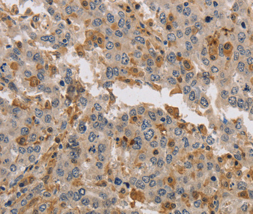 Immunohistochemistry of paraffin-embedded Human liver cancer tissue using KIF17 Polyclonal Antibody at dilution 1:40