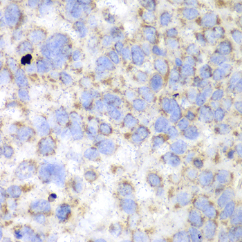 Immunohistochemistry of paraffin-embedded Human esophageal cancer using HADHA Polyclonal Antibody at dilution of 1:100 (40x lens).