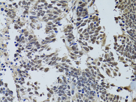 Immunohistochemistry of paraffin-embedded Human lung cancer using LKB1 Polyclonal Antibody at dilution of  1:100 (40x lens).