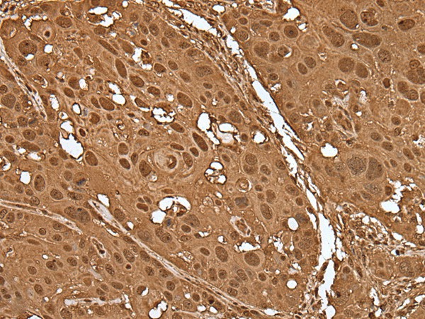 Immunohistochemistry of paraffin-embedded Human esophagus cancer tissue  using VCP Polyclonal Antibody at dilution of 1:30(?200)