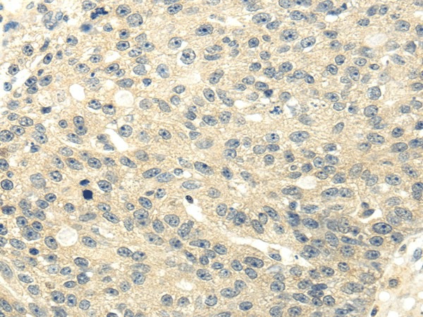 Immunohistochemistry of paraffin-embedded Human breast cancer using GAD1 Polyclonal Antibody at dilution of  1/20