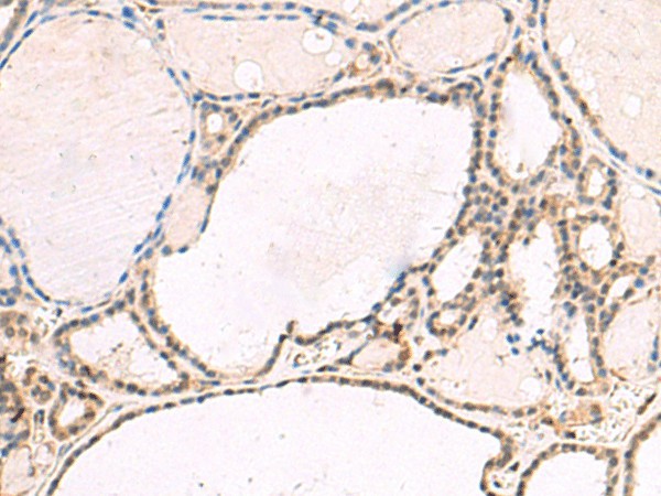 Immunohistochemistry of paraffin-embedded Human thyroid cancer tissue  using RNF13 Polyclonal Antibody at dilution of 1:60(?200)