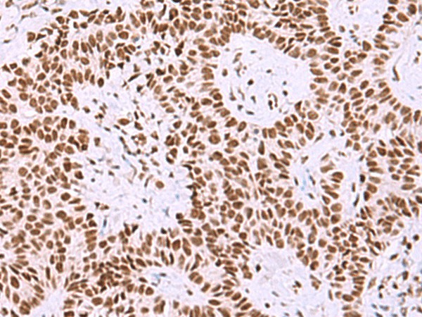 Immunohistochemistry of paraffin-embedded Human ovarian cancer tissue  using ISY1-RAB43 Polyclonal Antibody at dilution of 1:30(?200)