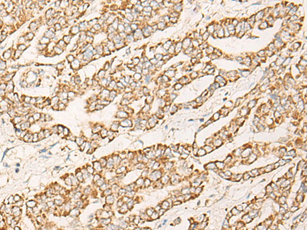 Immunohistochemistry of paraffin-embedded Human liver cancer tissue  using COX6C Polyclonal Antibody at dilution of 1:25(?200)