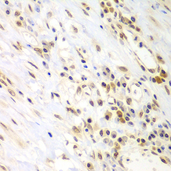 Immunohistochemistry of paraffin-embedded Human gastric cancer using LHX4 Polyclonal Antibody at dilution of 1:100 (40x lens).