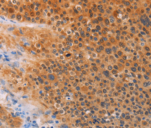 Immunohistochemistry of paraffin-embedded Human liver cancer tissue using ADHFE1 Polyclonal Antibody at dilution 1:30