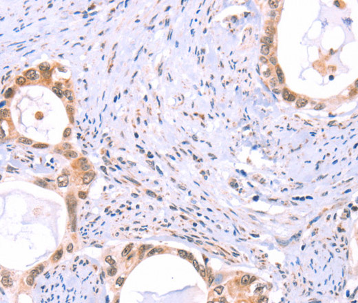 Immunohistochemistry of paraffin-embedded Human cervical cancer tissue using PROS1 Polyclonal Antibody at dilution 1:60