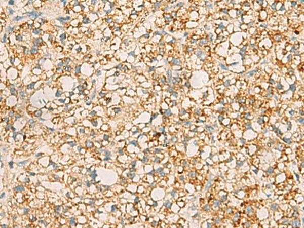 Immunohistochemistry of paraffin-embedded Human liver cancer tissue  using PDCL Polyclonal Antibody at dilution of 1:40(?200)