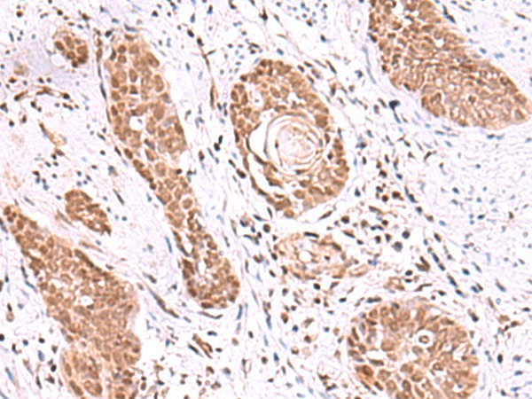 Immunohistochemistry of paraffin-embedded Human esophagus cancer tissue  using RUVBL1 Polyclonal Antibody at dilution of 1:85(?200)