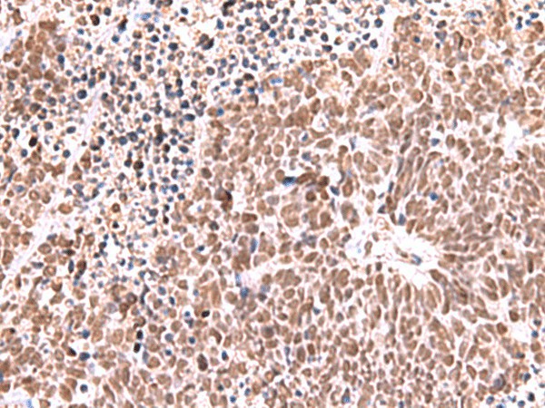 Immunohistochemistry of paraffin-embedded Human lung cancer tissue  using RCOR3 Polyclonal Antibody at dilution of 1:60(?200)