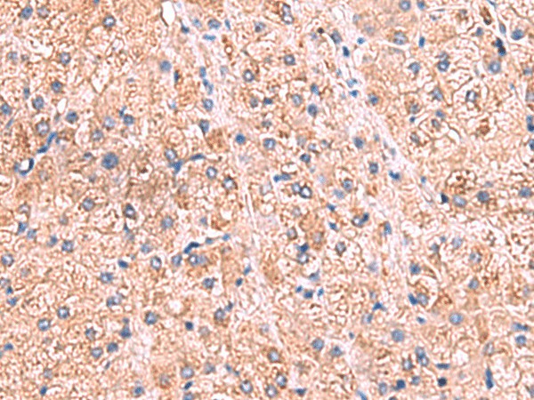 Immunohistochemistry of paraffin-embedded Human liver cancer tissue  using ZNF256 Polyclonal Antibody at dilution of 1:70(?200)