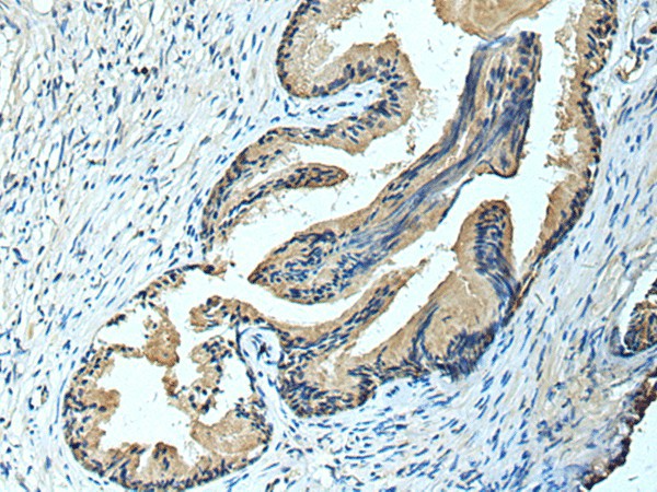 Immunohistochemistry of paraffin-embedded Human prost ate cancer tissue  using FCRLA Polyclonal Antibody at dilution of 1:90(?200)