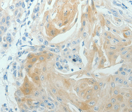 Immunohistochemistry of paraffin-embedded Human cervical cancer using RNF126 Polyclonal Antibody at dilution of 1:70