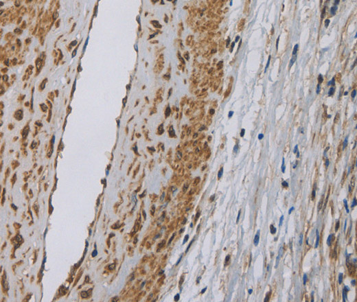 Immunohistochemistry of paraffin-embedded Human cervical cancer tissue using DCTN3 Polyclonal Antibody at dilution 1:50