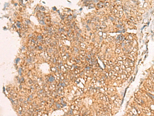 Immunohistochemistry of paraffin-embedded Human colorectal cancer tissue  using MOB1A Polyclonal Antibody at dilution of 1:50(?200)