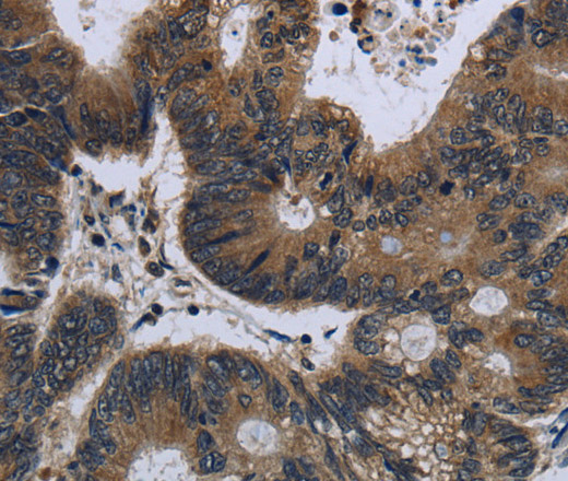 Immunohistochemistry of paraffin-embedded Human colon cancer tissue using GK1 Polyclonal Antibody at dilution 1:60