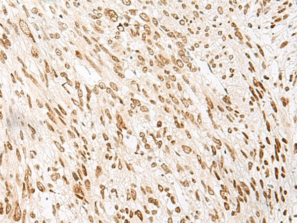 Immunohistochemistry of paraffin-embedded Human liver cancer tissue  using NHP2 Polyclonal Antibody at dilution of 1:55(?200)