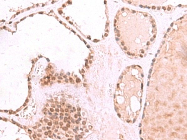 Immunohistochemistry of paraffin-embedded Human thyroid cancer tissue  using RUVBL1 Polyclonal Antibody at dilution of 1:85(?200)