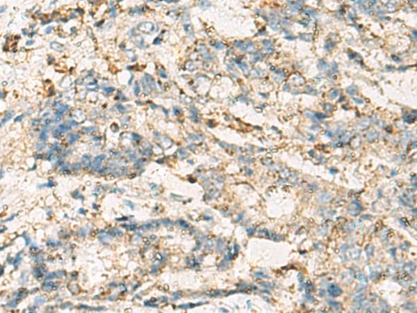 Immunohistochemistry of paraffin-embedded Human cervical cancer tissue  using VTA1 Polyclonal Antibody at dilution of 1:60(?200)