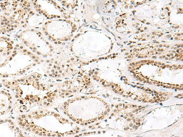 Immunohistochemistry of paraffin-embedded Human thyroid cancer tissue  using FKBP5 Polyclonal Antibody at dilution of 1:50(?200)