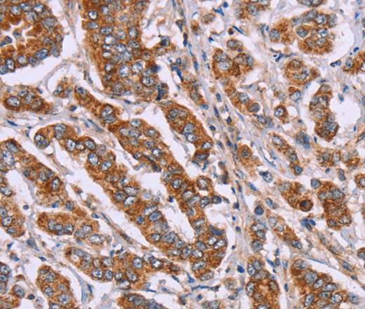 Immunohistochemistry of paraffin-embedded Human breast cancer tissue using DCTN6 Polyclonal Antibody at dilution 1:40