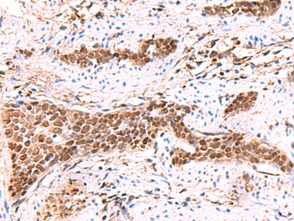 Immunohistochemistry of paraffin-embedded Human esophagus cancer tissue  using SOX2 Polyclonal Antibody at dilution of 1:35(?200)