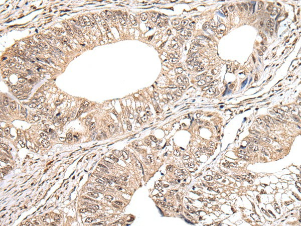 Immunohistochemistry of paraffin-embedded Human colorectal cancer tissue  using METAP1D Polyclonal Antibody at dilution of 1:40(?200)