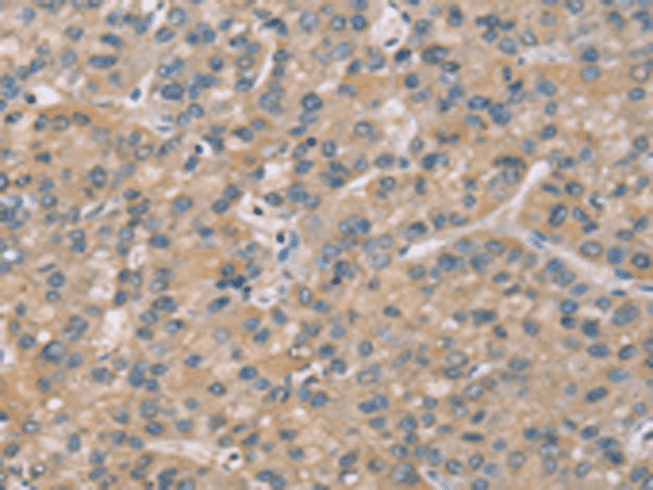 Immunohistochemistry of paraffin-embedded Human liver cancer tissue  using ZBTB3  Polyclonal Antibody at dilution of 1:50(?200)