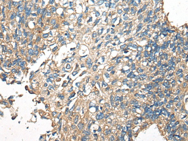 Immunohistochemistry of paraffin-embedded Human lung cancer tissue  using CDC42BPA Polyclonal Antibody at dilution of 1:60(?200)