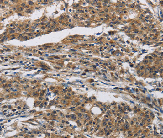 Immunohistochemistry of paraffin-embedded Human gastric cancer using IFNGR2 Polyclonal Antibody at dilution of 1:40