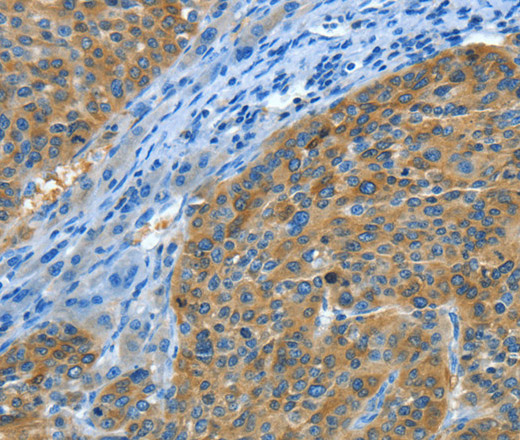 Immunohistochemistry of paraffin-embedded Human liver cancer tissue using Amphiphysin II Polyclonal Antibody at dilution 1:30